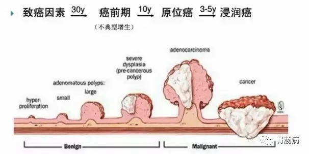 體檢查出腸息肉一定要切除！ 95%腸癌由它演變而來(lái)