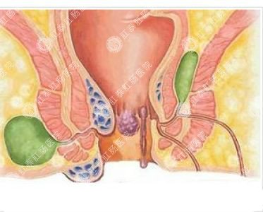 南寧哪個(gè)醫院可以做肛周膿腫？