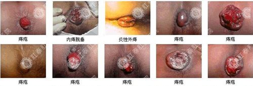 南寧治療痔瘡去哪家醫院好